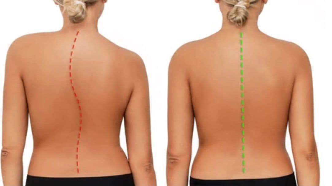 Skolyoz Rehabilitasyonu - 2