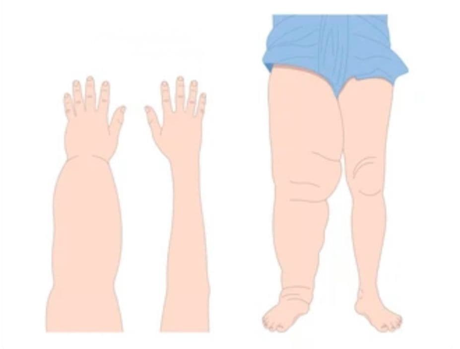 Lenfödem Terapisi - 1